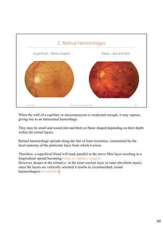 2. Retinal Hemorrhages
Superficial – flame shaped Deep – dot and blot
02-07-2020 Dept. of Ophthalmology, JNMC 60
When the wall of a capillary or microaneurysm is weakened enough, it may rupture,
giving rise to an intraretinal hemorrhage.
They may be small and round (dot and blot) or flame shaped depending on their depth
within the retinal layers.
Retinal haemorrhage spreads along the line of least resistance, constrained by the
local anatomy of the particular layer from which it arises.
Therefore, a superficial bleed will track parallel to the nerve fibre layer resulting in a
longitudinal spread becoming flame or splinter shaped.
However, deeper in the retina(i.e. in the inner nuclear layer or outer plexiform layer),
since the layers are vertically oriented it results in circumscribed, round
haemorrhages(dot and blot).
60
 