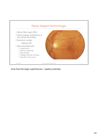 Flame shaped Hemorrhages
02-07-2020 Dept. of Ophthalmology, JNMC 61
• Nerve Fiber Layer (NFL)
• Flame shaped: architecture of
the retinal nerve fibers
• Excessive number:
Measure BP
• Also associated with:
• Hypertension
• Anemia, Leukemias
• Eales disease
• Collagen Vascular disorders
• Vasculitis of any cause
Arise from the larger superficial pre – capillary arterioles
61
 