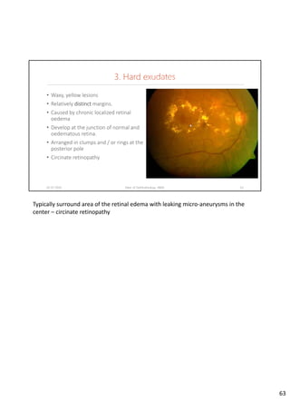 3. Hard exudates
• Waxy, yellow lesions
• Relatively distinct margins.
• Caused by chronic localized retinal 
oedema
• Develop at the junction of normal and 
oedematous retina. 
• Arranged in clumps and / or rings at the 
posterior pole
• Circinate retinopathy
02-07-2020 Dept. of Ophthalmology, JNMC 63
Typically surround area of the retinal edema with leaking micro‐aneurysms in the 
center – circinate retinopathy
63
 