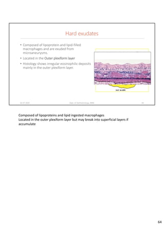 Hard exudates
• Composed of lipoprotein and lipid‐filled 
macrophages and are exuded from 
microaneurysms.
• Located in the Outer plexiform layer
• Histology shows irregular eosinophilic deposits 
mainly in the outer plexiform layer.
02-07-2020 Dept. of Ophthalmology, JNMC 64
Composed of lipoproteins and lipid ingested macrophages
Located in the outer plexiform layer but may break into superficial layers if 
accumulate
64
 