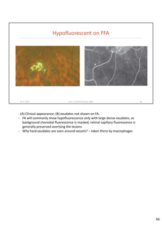 Hypofluorescent on FFA
02-07-2020 Dept. of Ophthalmology, JNMC 66
‐ (A) Clinical appearance; (B) exudates not shown on FA.
‐ FA will commonly show hypofluorescence only with large dense exudates, as 
background choroidal fluorescence is masked, retinal capillary fluorescence is 
generally preserved overlying the lesions
‐ Why hard exudates are seen around vessels? – taken there by macrophages
66
 