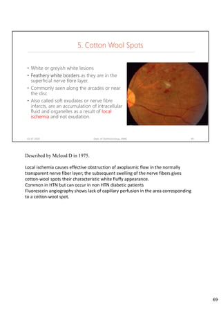 • White or greyish white lesions
• Feathery white borders as they are in the
superficial nerve fibre layer.
• Commonly seen along the arcades or near
the disc
• Also called soft exudates or nerve fibre
infarcts, are an accumulation of intracellular
fluid and organelles as a result of local
ischemia and not exudation.
02-07-2020 Dept. of Ophthalmology, JNMC 69
5. Cotton Wool Spots
Described by Mcleod D in 1975.
Local ischemia causes effective obstruction of axoplasmic flow in the normally 
transparent nerve fiber layer; the subsequent swelling of the nerve fibers gives 
cotton‐wool spots their characteristic white fluffy appearance. 
Common in HTN but can occur in non HTN diabetic patients
Fluorescein angiography shows lack of capillary perfusion in the area corresponding 
to a cotton‐wool spot.
69
 