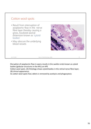 Cotton wool spots
• Result from interruption of
axoplasmic flow in the nerve
fibre layer thereby causing a
gross, localized axonal
distension known as ‘cytoid
bodies’
• May obscure the underlying
blood vessels
02-07-2020 Dept. of Ophthalmology, JNMC 70
Disruption of axoplasmic flow in axons results in the swollen ends known as cytoid
bodies (globular structures in the NFL) on HPE
Cotton wool spots. (A) Histology shows cytoid bodies in the retinal nerve fibre layer; 
(B) clinical appearance; 
As cotton wool spots heal, debris is removed by autolysis and phagocytosis
70
 