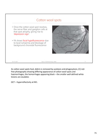 Cotton wool spots
• Once the cotton wool spot resolves,
the nerve fiber and ganglion cells at
that spot atrophy, giving rise to
‘depression sign’.
• FA shows focal hypofluorescence due
to local ischaemia and blockage of
background choroidal fluorescence
02-07-2020 Dept. of Ophthalmology, JNMC 71
As cotton wool spots heal, debris is removed by autolysis and phagocytosis; (C) red‐
free photography showing differing appearance of cotton wool spots and 
haemorrhages, the hemorrhages appearing black – the smaller well‐defined white 
lesions are exudates
OCT – hyperreflectivity at NFL
71
 