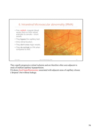 • Fine, reddish, irregular blood
vesses that run from retinal
arterioles to venules – shunt
vessels.
• They bypass the capillary bed.
• Intra-retinal location.
• They don’t cross major vessels,
• They do not leak on FFA when
compared to NVE.
02-07-2020 Dept. of Ophthalmology, JNMC 74
6. Intraretinal Microvascular abnormality (IRMA)
They signify progressive retinal ischemia and are therefore often seen adjacent to
areas of marked capillary hypoperfusion.
FA shows focal hyperfluorescence associated with adjacent areas of capillary closure
(‘dropout’) but without leakage.
74
 