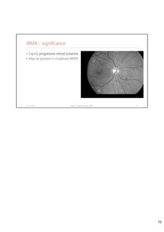 IRMA - significance
02-07-2020 Dept. of Ophthalmology, JNMC 75
• Signify progressive retinal ischemia
• May be present in moderate NPDR.
75
 