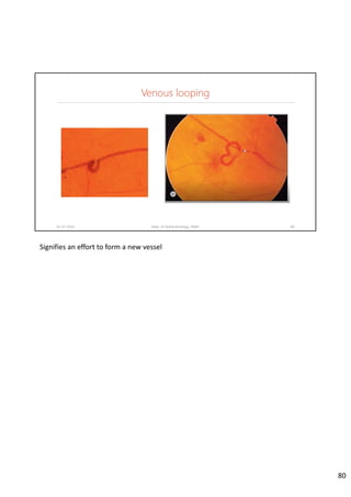 Venous looping
02-07-2020 Dept. of Ophthalmology, JNMC 80
Signifies an effort to form a new vessel
80
 