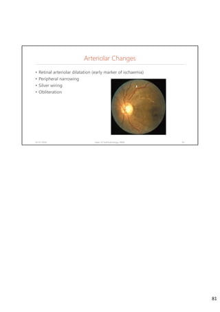 Arteriolar Changes
• Retinal arteriolar dilatation (early marker of ischaemia)
• Peripheral narrowing
• Silver wiring
• Obliteration
02-07-2020 Dept. of Ophthalmology, JNMC 81
81
 