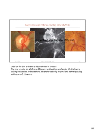 Neovascularization on the disc (NVD)
02-07-2020 Dept. of Ophthalmology, JNMC 86
Grow on the disc or within 1 disc diameter of the disc
Grow on the disc or within 1 disc diameter of the disc
Disc new vessels. (A) Moderate; (B) severe with cotton‐wool spots; (C) FA showing 
leaking disc vessels, with extensive peripheral capillary dropout and a small focus of 
leaking vessels elsewhere
86
 