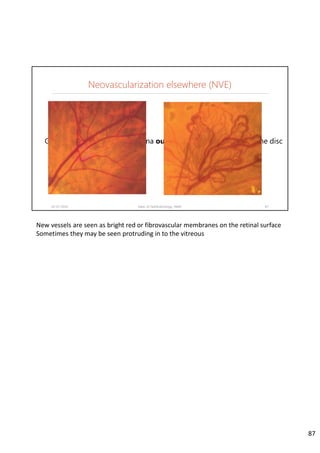 Neovascularization elsewhere (NVE)
02-07-2020 Dept. of Ophthalmology, JNMC 87
Grow on the surface of the retina outside one disc diameter of the disc
New vessels are seen as bright red or fibrovascular membranes on the retinal surface
Sometimes they may be seen protruding in to the vitreous
87
 