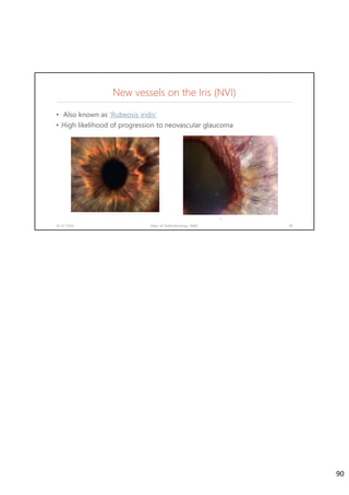New vessels on the Iris (NVI)
• Also known as ‘Rubeosis iridis’
• High likelihood of progression to neovascular glaucoma
02-07-2020 Dept. of Ophthalmology, JNMC 90
90
 