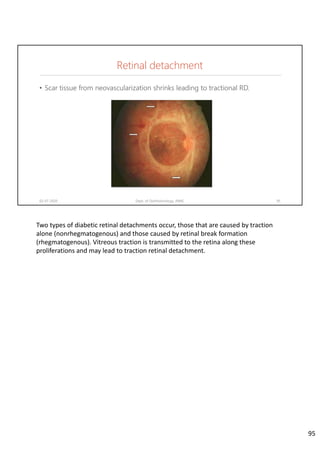 • Scar tissue from neovascularization shrinks leading to tractional RD.
02-07-2020 Dept. of Ophthalmology, JNMC 95
Retinal detachment
Two types of diabetic retinal detachments occur, those that are caused by traction 
alone (nonrhegmatogenous) and those caused by retinal break formation 
(rhegmatogenous). Vitreous traction is transmitted to the retina along these 
proliferations and may lead to traction retinal detachment.
95
 