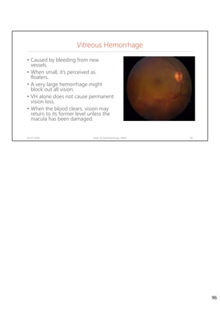 • Caused by bleeding from new
vessels.
• When small, it’s perceived as
floaters.
• A very large hemorrhage might
block out all vision.
• VH alone does not cause permanent
vision loss.
• When the blood clears, vision may
return to its former level unless the
macula has been damaged.
02-07-2020 Dept. of Ophthalmology, JNMC 96
Vitreous Hemorrhage
96
 