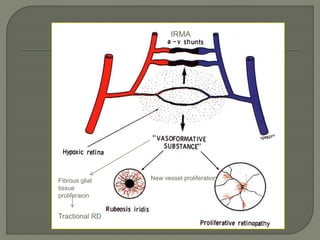 New vessel proliferation
Fibrous glial
tissue
proliferaion
Tractional RD
RD
IRMA
 