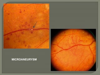 MICROANEURYSM
 