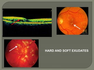 HARD AND SOFT EXUDATES
 
