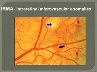 IRMA- Intraretinal microvascular anomalies
 