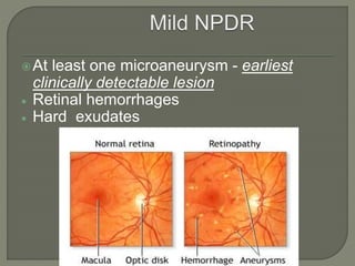 At least one microaneurysm - earliest
clinically detectable lesion
 Retinal hemorrhages
 Hard exudates
 