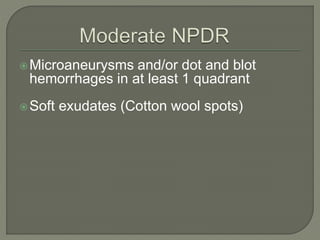 Microaneurysms and/or dot and blot
hemorrhages in at least 1 quadrant
Soft exudates (Cotton wool spots)
 