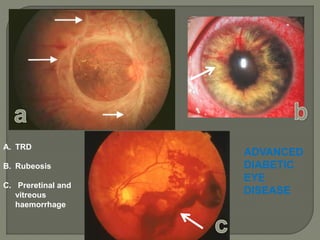 ADVANCED
DIABETIC
EYE
DISEASE
A. TRD
B. Rubeosis
C. Preretinal and
vitreous
haemorrhage
 