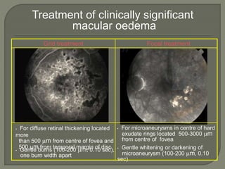 Treatment of clinically significant
macular oedema
• For microaneurysms in centre of hard
exudate rings located 500-3000 m
from centre of fovea
Focal treatment
• Gentle whitening or darkening of
microaneurysm (100-200 m, 0.10
sec)
• For diffuse retinal thickening located
more
than 500 m from centre of fovea and
500 m from temporal margin of disc
Grid treatment
• Gentle burns (100-200 m, 0.10 sec),
one burn width apart
 