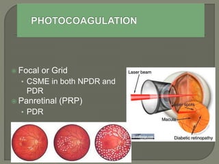  Focal or Grid
• CSME in both NPDR and
PDR
 Panretinal (PRP)
• PDR
 