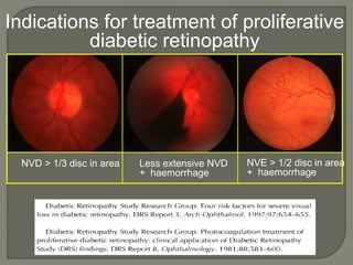 Indications for treatment of proliferative
diabetic retinopathy
NVD > 1/3 disc in area Less extensive NVD
+ haemorrhage
NVE > 1/2 disc in area
+ haemorrhage
 