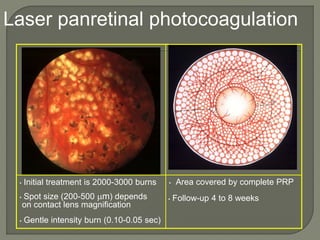 • Spot size (200-500 m) depends
on contact lens magnification
• Gentle intensity burn (0.10-0.05 sec)
• Follow-up 4 to 8 weeks
• Area covered by complete PRP
• Initial treatment is 2000-3000 burns
Laser panretinal photocoagulation
 
