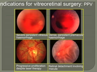 Indications for vitreoretinal surgery: PPV
Retinal detachment involving
macula
Severe persistent vitreous
haemorrhage
Dense, persistent premacular
haemorrhage
Progressive proliferation
despite laser therapy
 