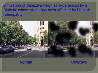Simulation of defective vision as experienced by a
Diabetic whose vision has been affected by Diabetic
retinopathy
Normal Defective
 