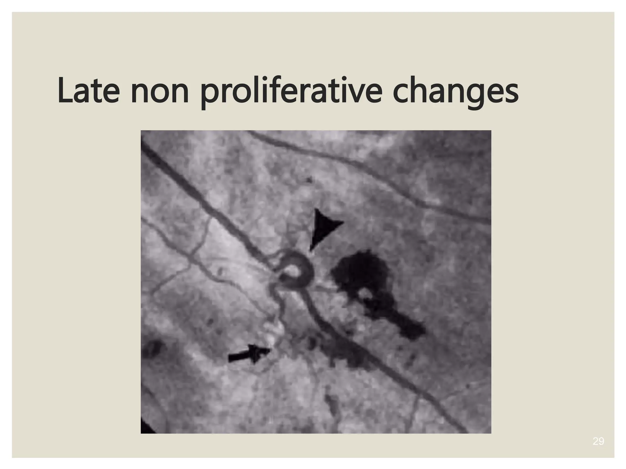 Late non proliferative changes
29
 