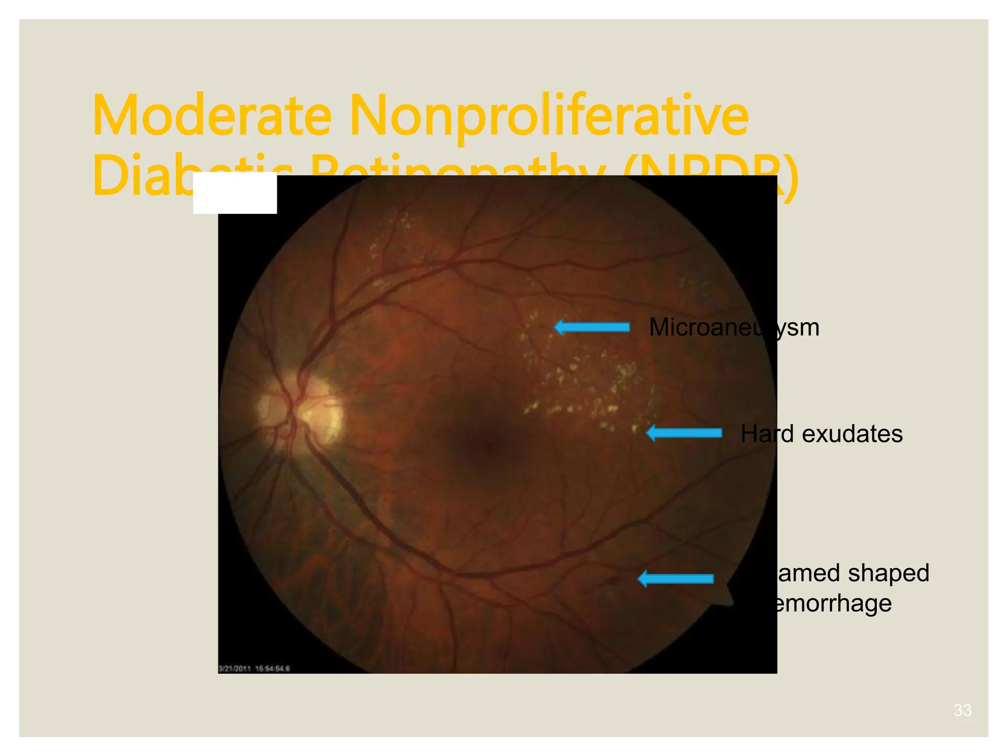 Moderate Nonproliferative
Diabetic Retinopathy (NPDR)
33
Hard exudates
Flamed shaped
hemorrhage
Microaneurysm
 