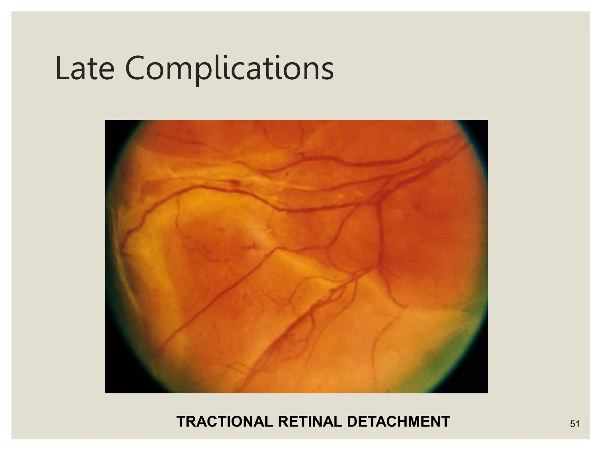 Late Complications
51
TRACTIONAL RETINAL DETACHMENT
 