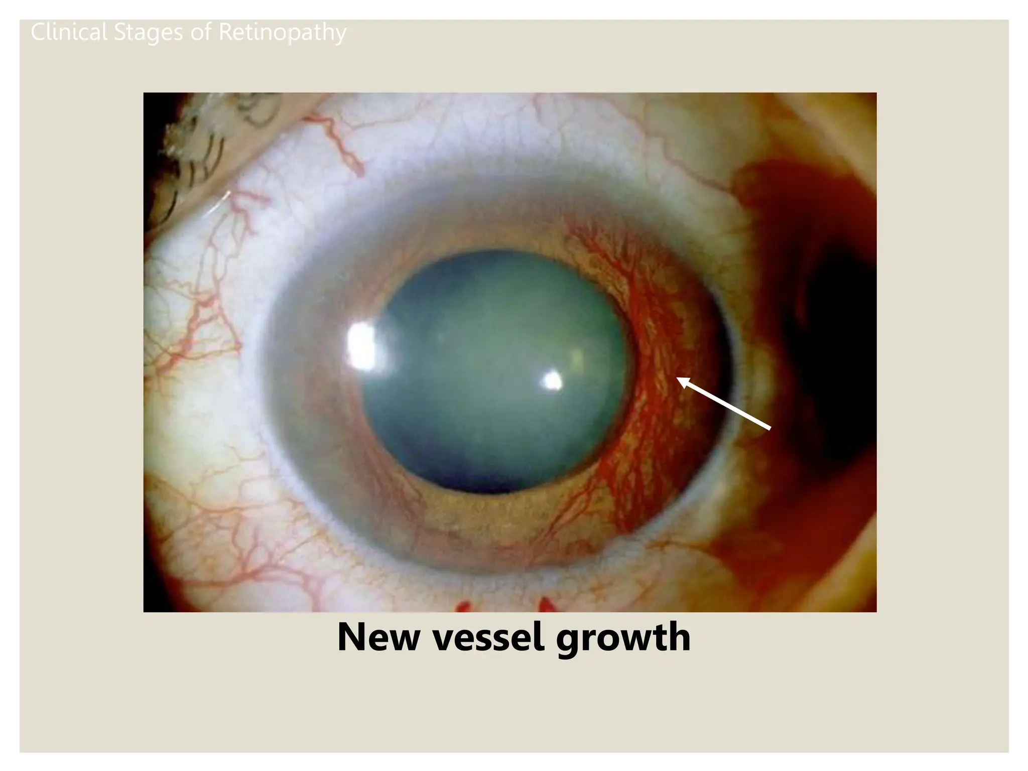 Clinical Stages of Retinopathy
New vessel growth
 
