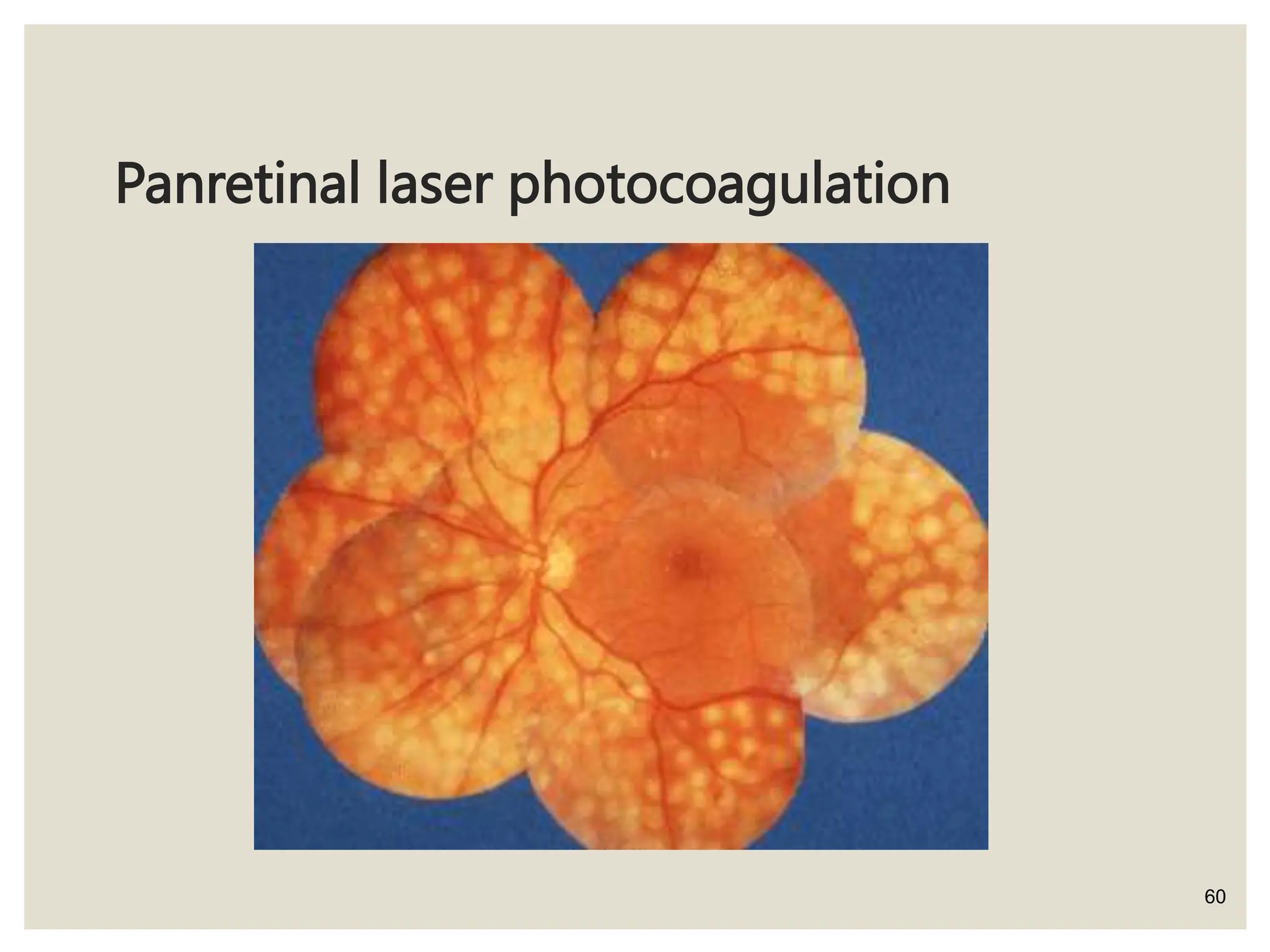 Panretinal laser photocoagulation
60
 