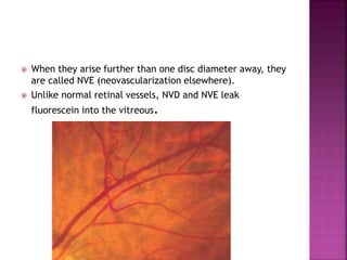 Nvd Optometry Diabetic retinopathy.pptx on diabetic changes in Retina | PPTX