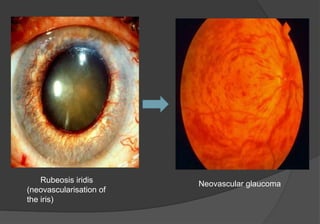Comprehensive Overview of Diabetic Retinopathy: Risks, Diagnosis, and ...