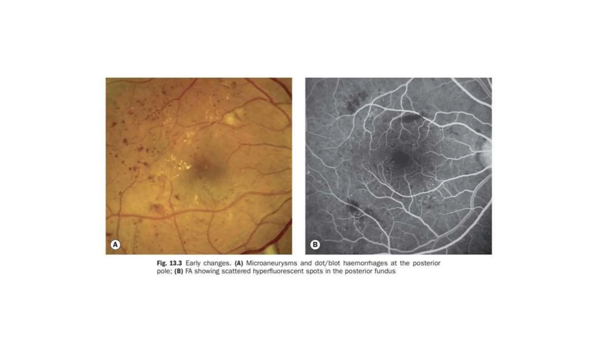 DIABETIC RETINOPATHY-postgraduate teaching.pptx