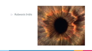 Comprehensive Overview of Diabetic Retinopathy: Risk Factors, Stages ...