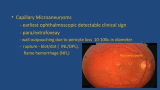 • Capillary Microaneurysms
- earliest ophthalmoscopic detectable clinical sign
- para/extrafoveay
- wall outpouching due to pericyte loss 10-100u in diameter
- rupture - blot/dot ( INL/OPL),
flame hemorrhage (NFL) Microaneurysms
 