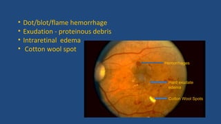 • Dot/blot/flame hemorrhage
• Exudation - proteinous debris
• Intraretinal edema
• Cotton wool spot
Hard exudate
edema
Cotton Wool Spots
Hemorrhages
 