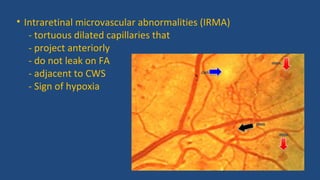 • Intraretinal microvascular abnormalities (IRMA)
- tortuous dilated capillaries that
- project anteriorly
- do not leak on FA
- adjacent to CWS
- Sign of hypoxia
IRMA
IRMA
IRMA
CWS
 