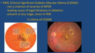 • DME /Clinical Significant Diabetic Macular Edema (CSDME)
- not a criterion of severity of NPDR
- leading cause of legal blindness in diabetics
- present at any stage, more in PDR
3 criteria of CSDME
 