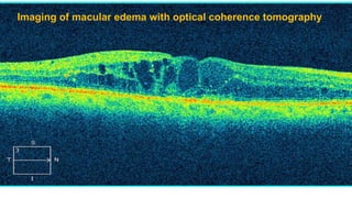 Imaging of macular edema with optical coherence tomography
 