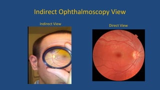Indirect Ophthalmoscopy View
Indirect View Direct View
 