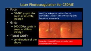 Laser Photocoagulation for CSDME
 