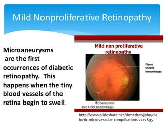 Mild Nonproliferative Retinopathy
Microaneurysms
are the first
occurrences of diabetic
retinopathy. This
happens when the tiny
blood vessels of the
retina begin to swell.
http://www.slideshare.net/drmathewjohn/dia
betic-microvascular-complications-2222895
 