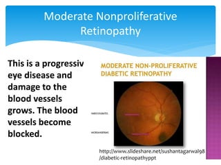 Moderate Nonproliferative
Retinopathy
This is a progressive
eye disease and
damage to the
blood vessels
grows. The blood
vessels become
blocked.
http://www.slideshare.net/sushantagarwal98
/diabetic-retinopathyppt
 