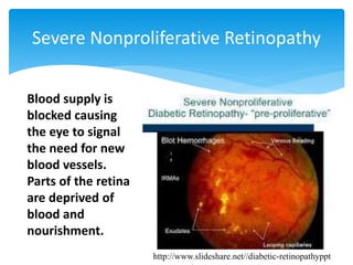 Severe Nonproliferative Retinopathy
Blood supply is
blocked causing
the eye to signal
the need for new
blood vessels.
Parts of the retina
are deprived of
blood and
nourishment.
http://www.slideshare.net//diabetic-retinopathyppt
 