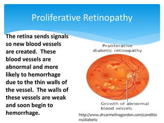 Proliferative Retinopathy
The retina sends signals
so new blood vessels
are created. These
blood vessels are
abnormal and more
likely to hemorrhage
due to the thin walls of
the vessel. The walls of
these vessels are weak
and soon begin to
hemorrhage. http://www.drcarmelinagordon.com/conditio
ns/diabetic
 